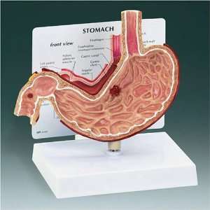  Stomach with Ulcers Model
