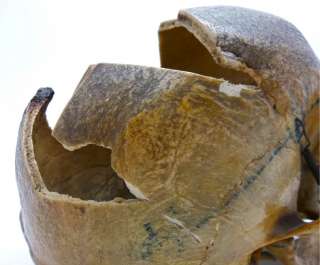 Old Antique REAL Human Skull   Genuine Skeleton   RARE Star Shaped 