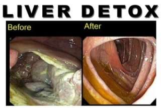 100X Parasite Cleanse DETOX Liver Colon Yeast Blood KILL Food Poison 